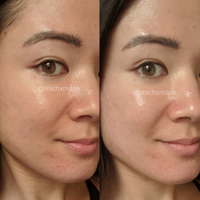 proskin-facial-before-after